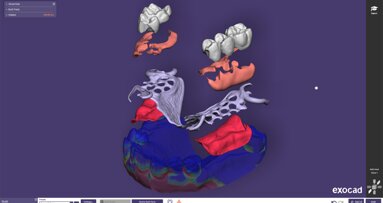 Exocad presenta PartialCAD 3.2 Elefsina para una mayor flexibilidad en el diseño de prótesis parciales