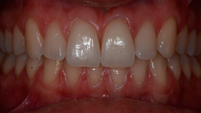 L’adherence ai protocolli operativi di prevenzione con approccio clinico D-BIOTECH (Dental BIOfilm Detection Topographic Technique)