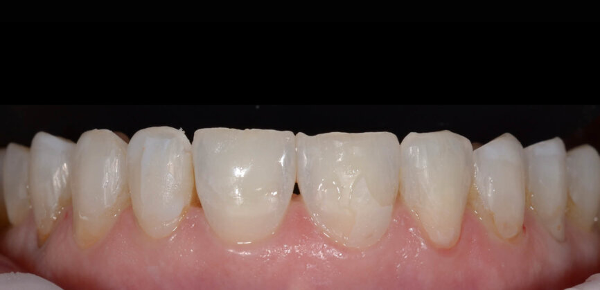 Fig. 2: Orthodontic treatment was performed to align the full arch. 