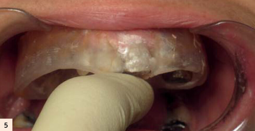 Gouttière pour empreinte fractionnée en fin de chirurgie.