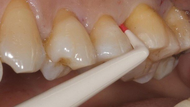 Biomateriali biomimetici nella rigenerazione dei difetti parodontali