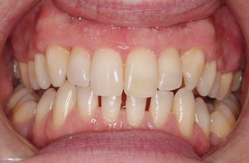 Fig. 16: Post-treatment anterior view