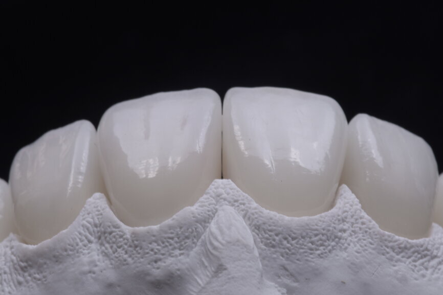 Fig. 73: Glazed ceramic veneers on the plaster model.