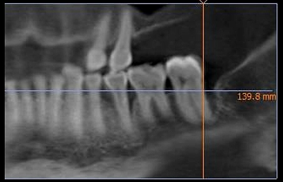 Fig. 4 - RX preoperatoria che evidenzia il difetto osseo sull’elemento 3.7.