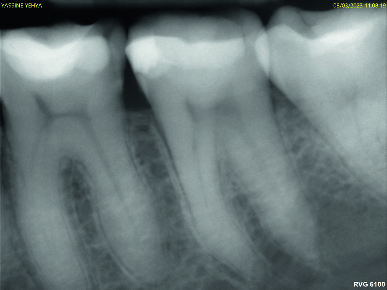 Fig. 10 : Radio à 12 ans de suivi.