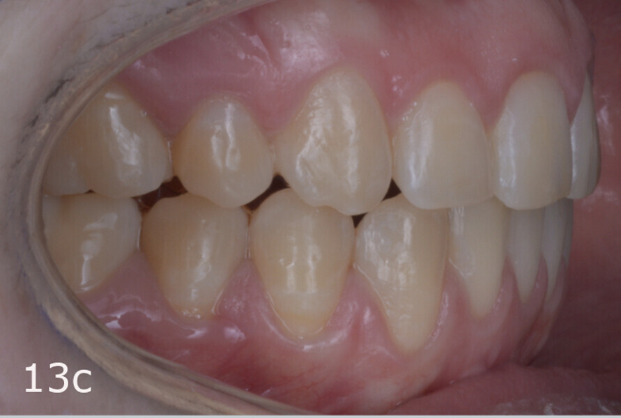 Figs. 13a–f: Final situation. The lack of overjet and overbite and the midlines had been improved and anterior and canine guidance achieved.