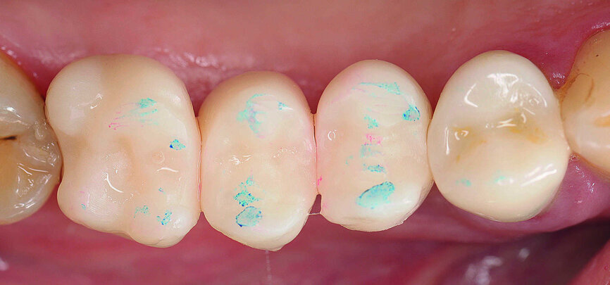 Fig. 23 : Vérification de l’occlusion et ajustement des prototypes