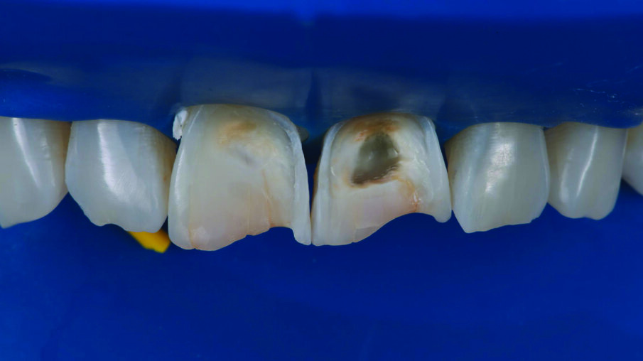 Detailed view of the maxillary incisors. The teeth didn’t show any highly translucent areas, so the use of a single shade/opacity of 3M™ Filtek™ Universal Restorative was selected.