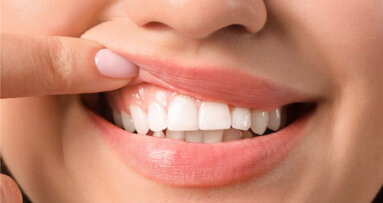 „Gingiva-Bleaching“ gegen dunkle Zahnfleischverfärbungen
