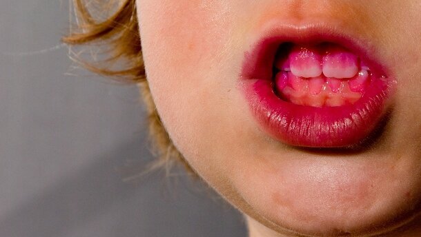 Tandplaque wellicht bruikbaar in strijd tegen gaatjes en tandvleesontstekingen