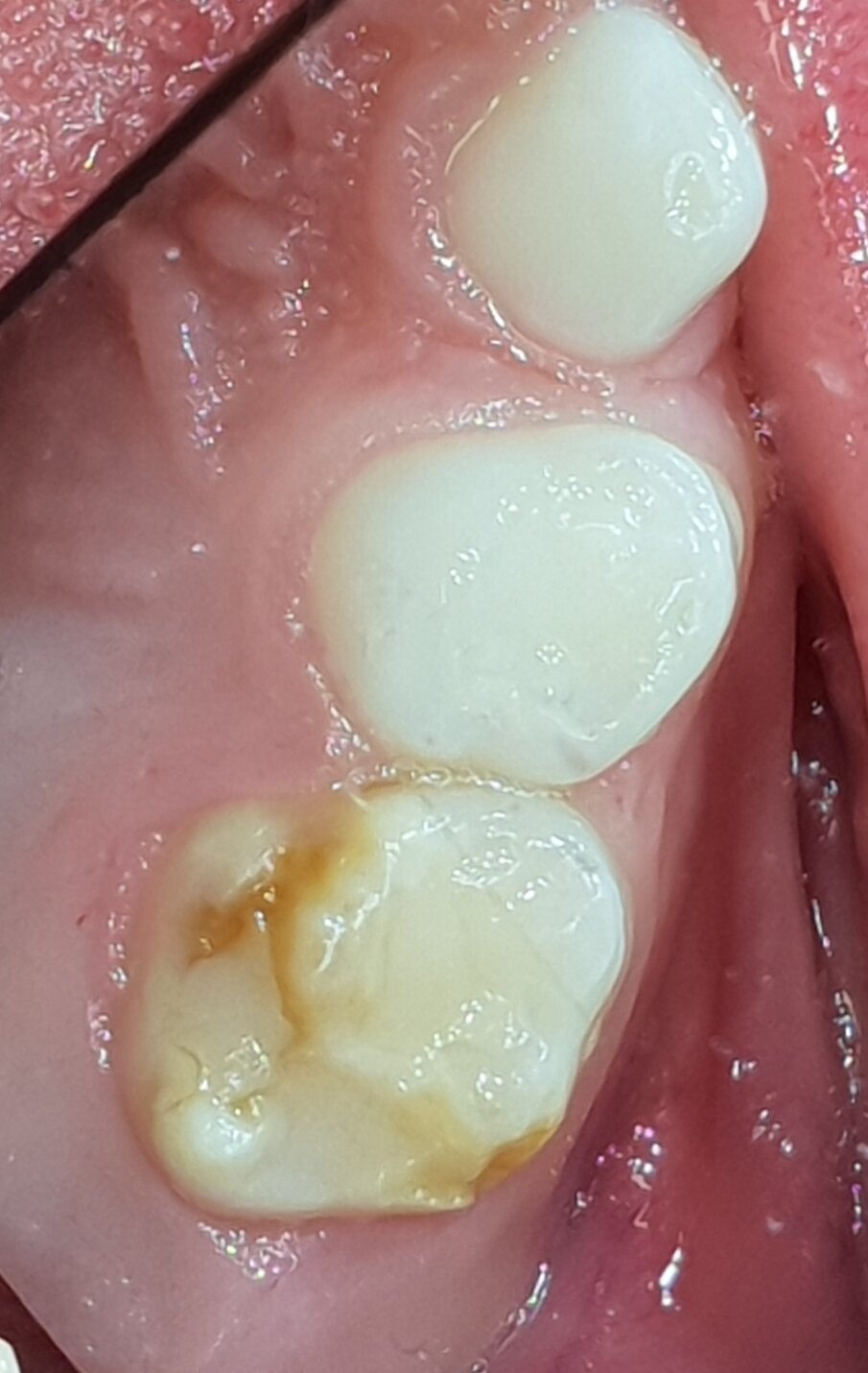 Afbeelding 4a. Resultaat ART in plaats van narcosebehandeling na drie jaar.