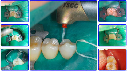 Láser en Odontología Conservadora (8)