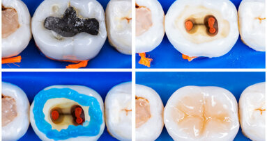 Całkowity zakaz stosowania wypełnień amalgamatowych