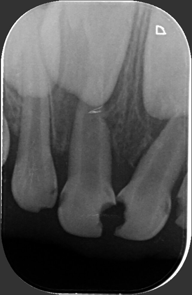 Fig. 2: Radiographic examination revealed pulpal involvement of caries in 51 and 61.