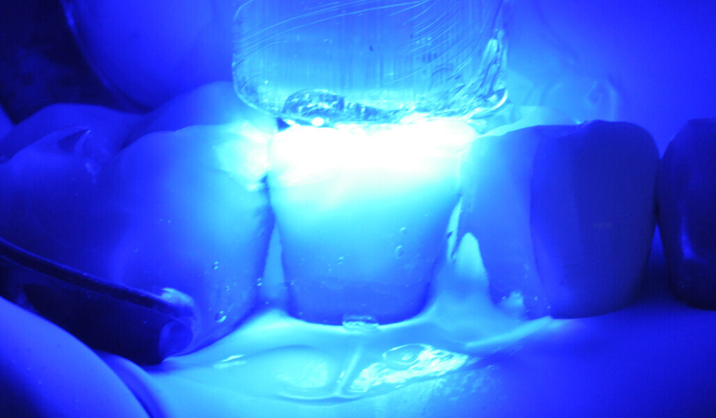 Fig. 23: Light polymerisation through a layer of glycerine gel to prevent the formation of an oxygen inhibition layer. 