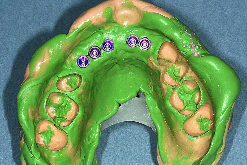 Fig. 19: Removal of the impression and fitting of the impression copings with their laboratory equivalent.