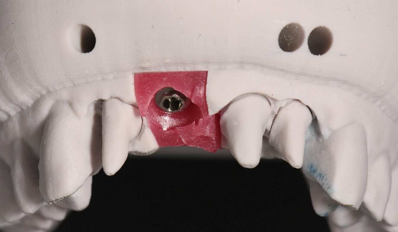 Fig. 5: Printed model with gingival mask.
