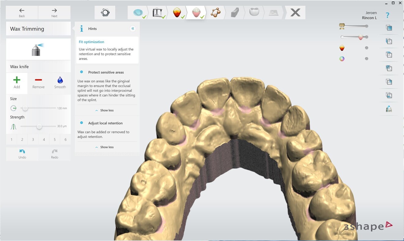 Fig. 4: During the design of the splint, if we add material to the palatal gingival margins, we avoid any local pressure and increase the comfort when the splint is worn.