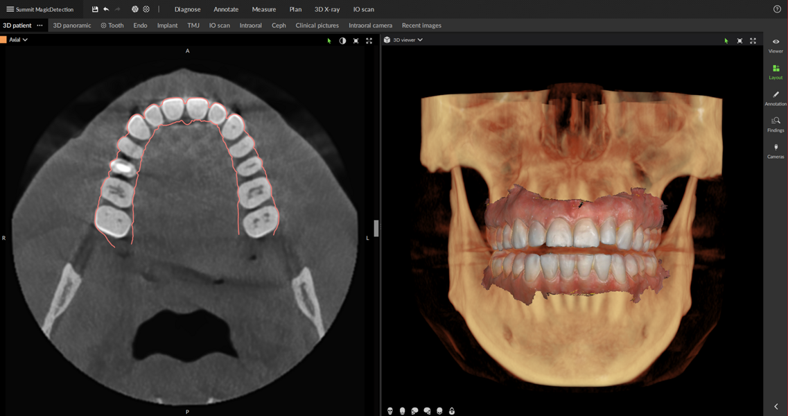 SmartFusion-Funktion in DTX. © DEXIS