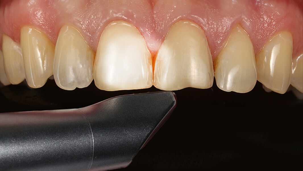 Fig. 6. Se escaneó la situación clínica con CEREC Omnicam.