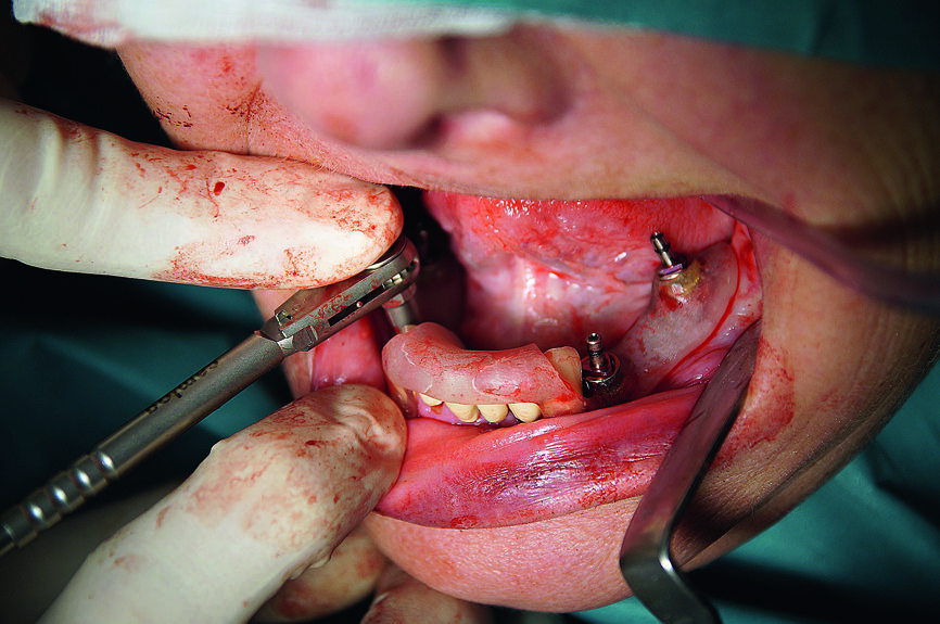 Fig. 9 : Insertion manuelle des implants guidés au moyen de la clé dynamométrique verrouillée.