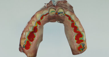 Technologie digitálního otiskování v současné stomatologické praxi