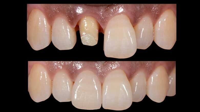 Rehabilitación estética de un diente anterior