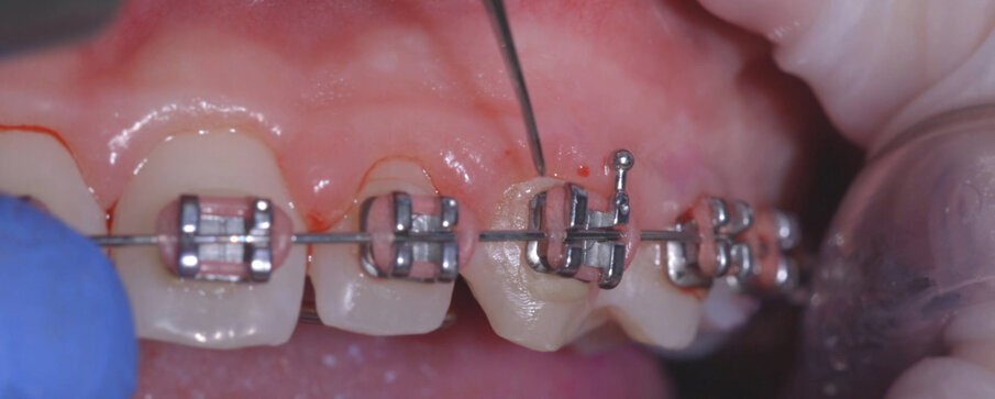 Fig. 6 - Questo protocollo si distingue per il suo comfort e consente la pianificazione di sedute di profilassi di richiamo senza resistenza da parte del paziente.