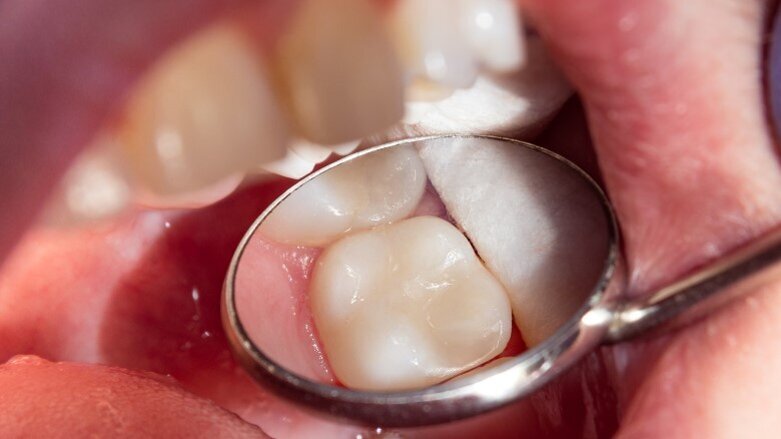 Study analyses MB2 root canal prevalence among world population