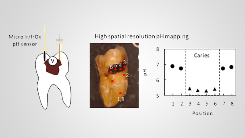 New microsensor for pH mapping joins the fight against dental caries