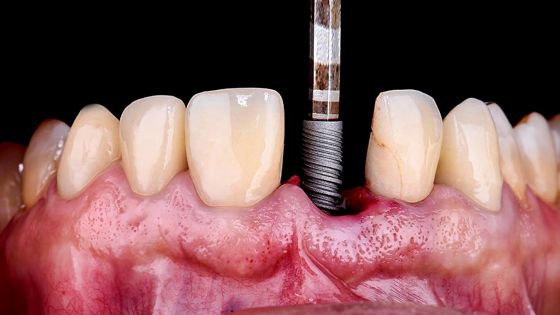 A fully digital approach to soft-tissue and aesthetic excellence