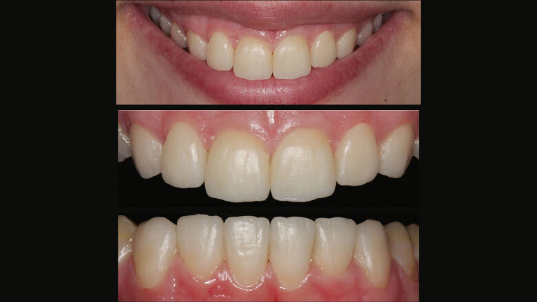 Figure 10: Wax-up for the examination of the phonetics, function and esthetics