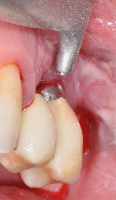 Fig.15: Case 2. Supra-gingival biofilm removal with erythritol powder.