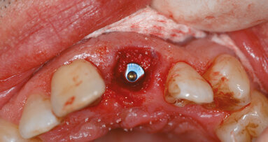 Nuove soluzioni implanto-protesiche nell’impianto post-estrattivo immediato