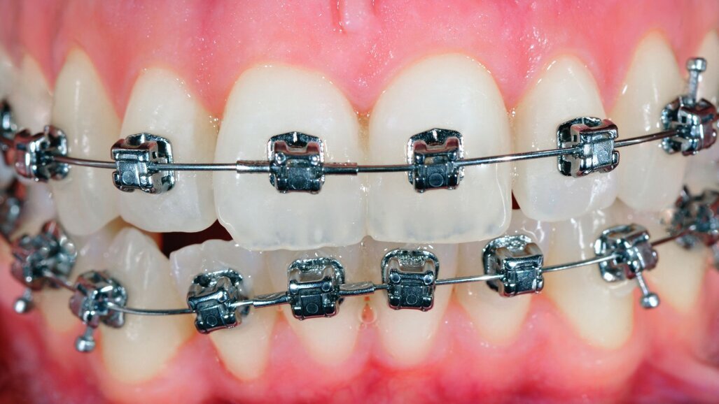 Salivary biomarkers to monitor orthodontic treatments biologically
