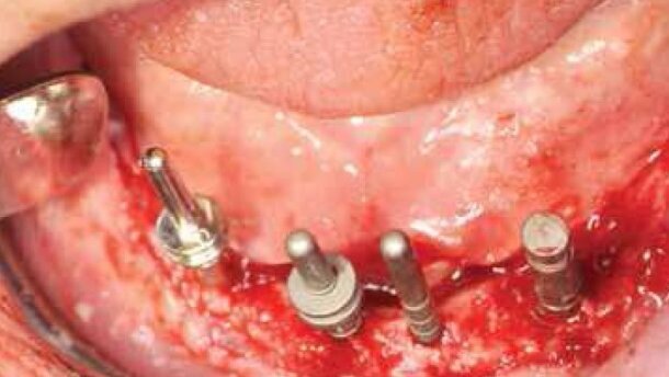 Leczenie implantoprotetyczne atroficznej żuchwy