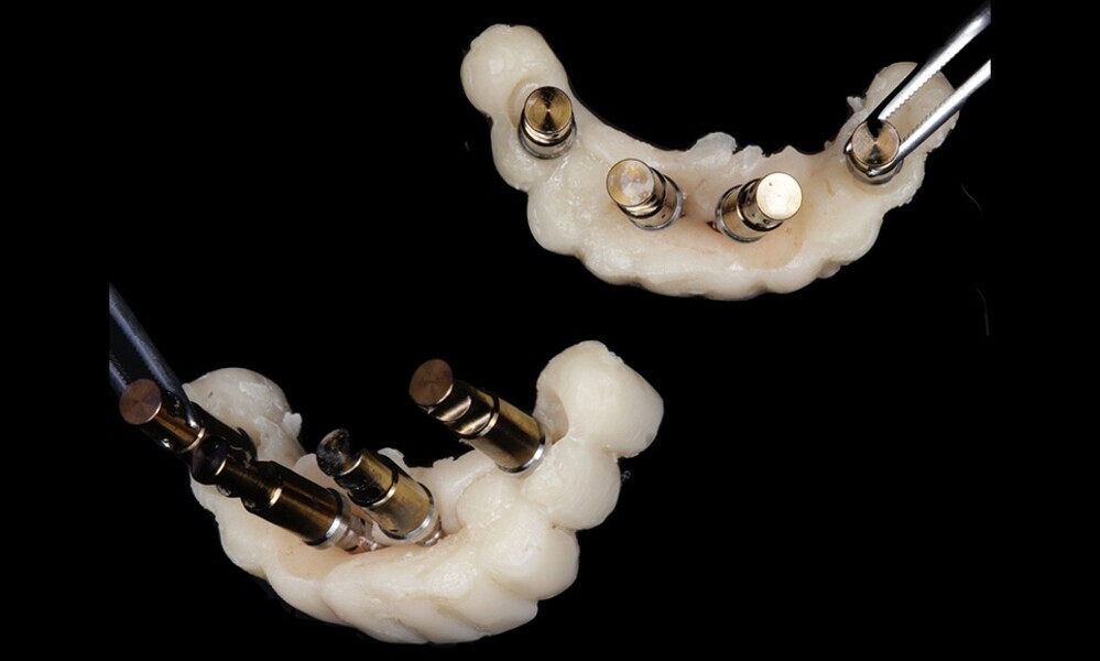 Figs. 47–50: The provisional restoration was fabricated. Variobase abutments were placed on the screw-retained abutments for enhanced stability and support of the provisional restoration.