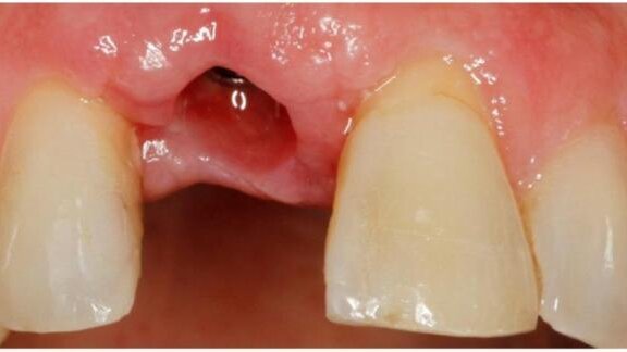Wykorzystanie technologii cyfrowych podczas uzupełniania braku siekacza przyśrodkowego szczęki