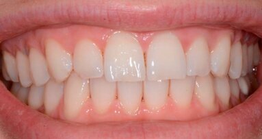 Approccio terapeutico combinato sbiancamento e Infiltrazione Icon della White Spot Lesions (WSL)