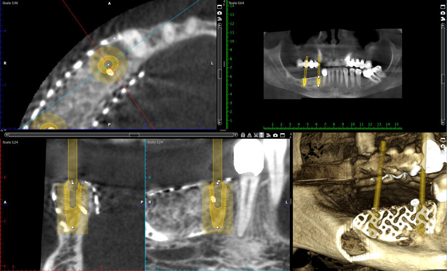 Fig. 7_Sezione di CBCT a distanza di 6 mesi dall’intervento ricostruttivo che mostra il notevole incremento osseo e la pianificazione pre-implantare.