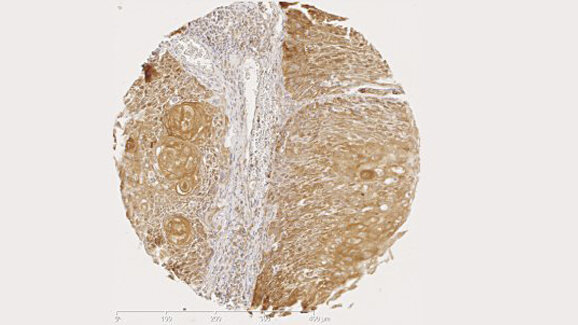 Istraživanjem ljudskih mikroba postiže se bolji uvid u parodontitis