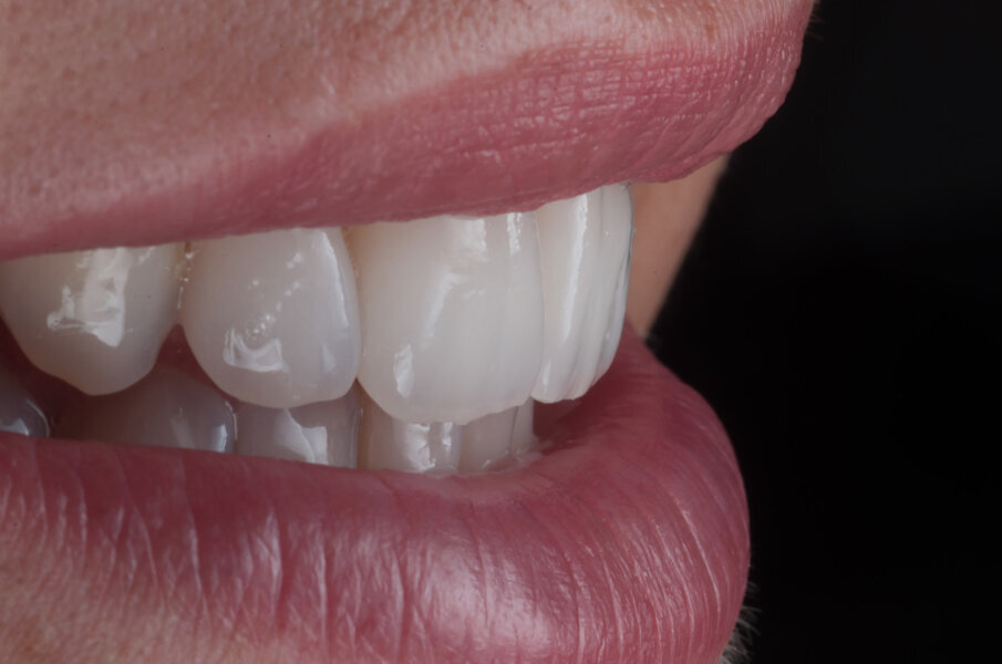 Figs. 20–23: Definitive restoration with all the texture details on the restorations in the mouth.