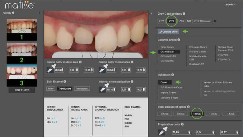 Intégrer la teinte d’une incisive centrale unitaire du premier coup