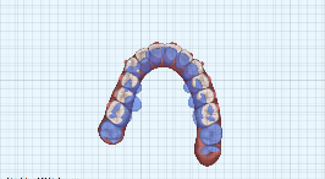 Fig. 28: Orthodontic digital simulation using Invisalign software to show the pre-treatment position (blue) and the predicted result after treatment (white).