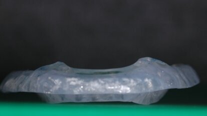 Variazioni della funzione visiva e dell’appoggio podalico in pazienti con disfunzioni cranio-cervico-mandibolari, trattati con riposizionamento mandibolare in avanzamento