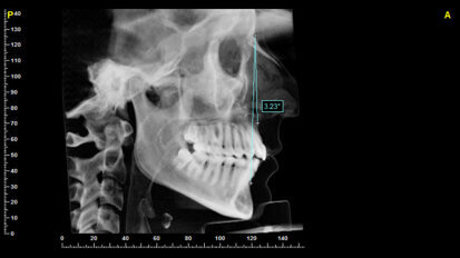 Ruolo della posizione degli incisivi nella preparazione ortodontica pre-chirurgica