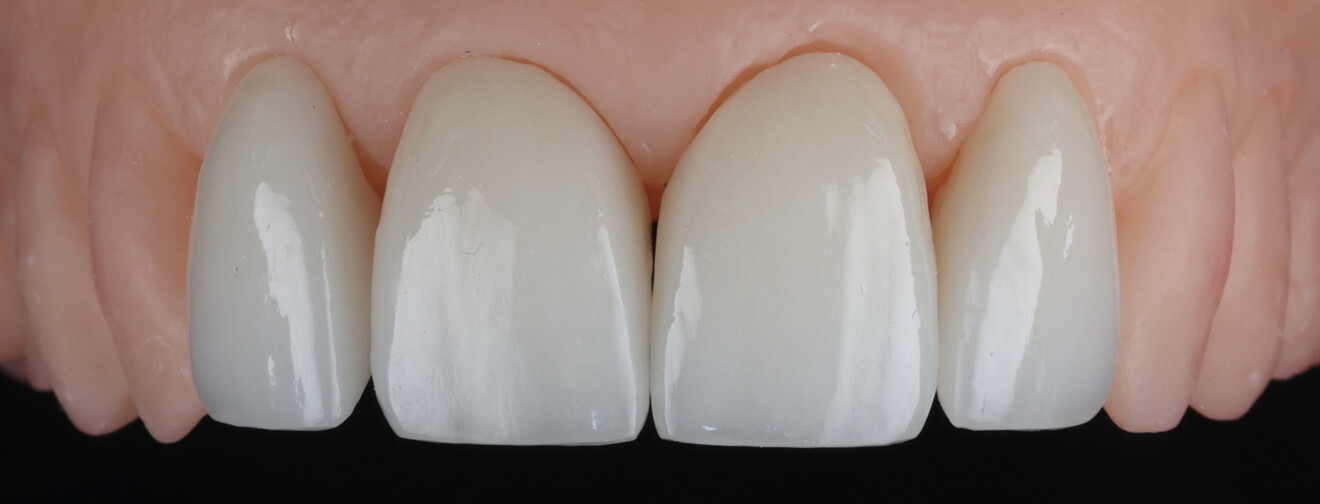 Fig. 10: Laboratory-fabricated IPS e.max CAD veneers prior to clinical try-in, showing medium translucency.