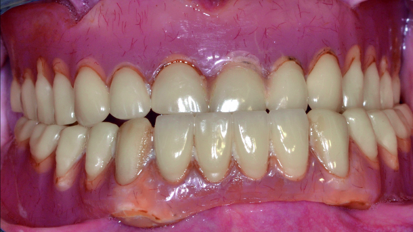 Veneering options for fixed implant-retained restorations