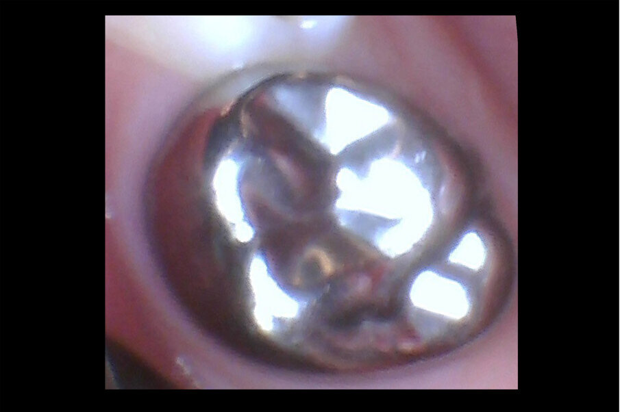 Afbeelding 11a-b. Casus 3: 23-01-20. In november met Hall-techniek geplaatste kroon met ‘50%-prognose’ om enerzijds pijn en anderzijds narcose te voorkomen.