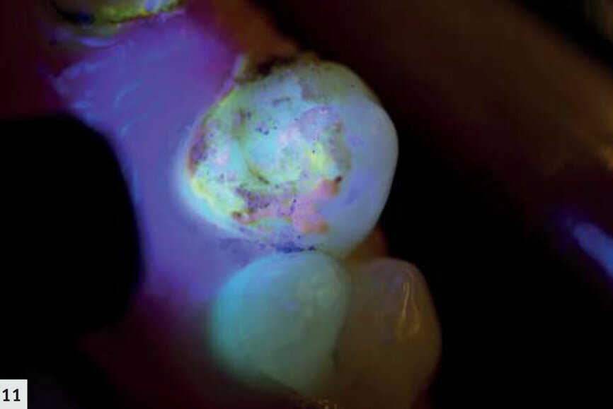 Figs. 11–12 : Bridge adhésif détaché. La fluorescence rouge émise par les porphyrines, les produits métaboliques des bactéries buccales, démontre la présence d’un biofilm mature. 